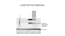 Skin Rejuvenation and Tattoo Removal